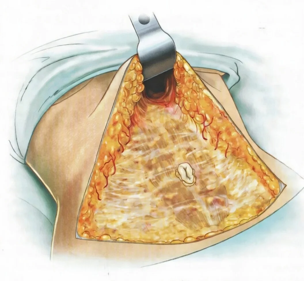 Pós-Operatório e Recuperação